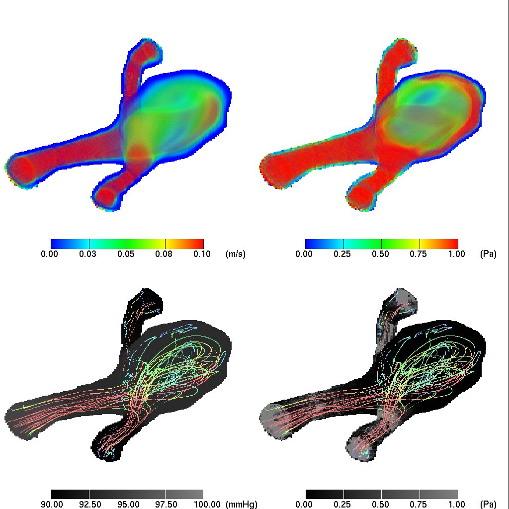 Renderings of a brain aneurysm